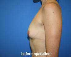 plastic-surgery-breast-augmentation